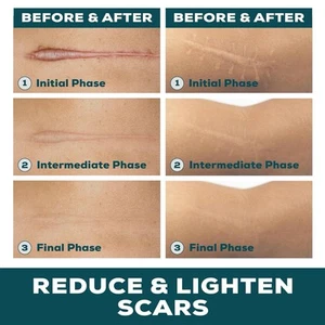 Silicone Scar Sheets Tape Roll Reusable Strips Surgical Keloid Scars 1.6”x79” 2M - Picture 1 of 9