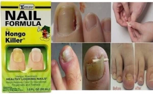 NAIL FORMULA di HONGO KILLER aiuta a mantenere unghie dall'aspetto sano 1 oncia - Foto 1 di 6
