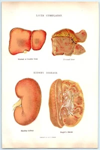 1916 Liver Disease Kidney Bright's Disease Print Book Plate EJ Stanley KK - Picture 1 of 2