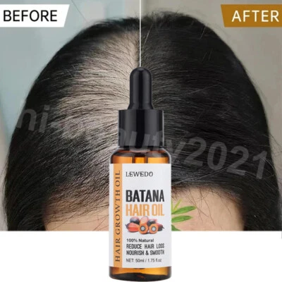 Pure BATANA Oil ORGANIC-For Hair Growth-Pure & Natural for Anti Hair Loss Serum - Image 1 of 4
