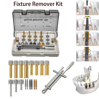 Kit de remoção de acessório dental NeoBiotech FR ferramenta de remoção de implante com chave de torque - Imagem 1 de 4