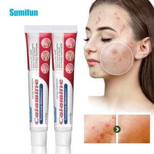 New 20g Rosacea Ointment Treat Red Nose Acne Cream Pimple Scar Repair Skin Care - Picture 1 of 18