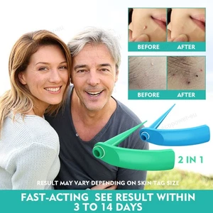 2in1 Warzenentferner Kit Warze Papillome Skin Tag Remover Schmerzloser Entferner - Picture 1 of 18