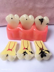 4 Times Dental Caries Evolution Model Detachable Teeth Disease Base Teach Model - Picture 1 of 13