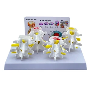 Lumbar Vertebrae Anatomy Model Nursing Model 4 Stages Lesions Comparative Model - Picture 1 of 8