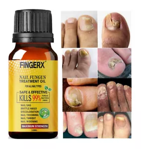 BEST Fungal Nail Treatment - Stops Toenail, Finger, Fungus Infections UK - Picture 1 of 1