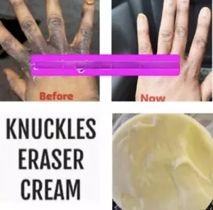 DARK KNUCKLES SKIN WHITENING LIGHTENING KOJIC ACID, GLYCOLIC ACID FACE CREAM . - Picture 1 of 1