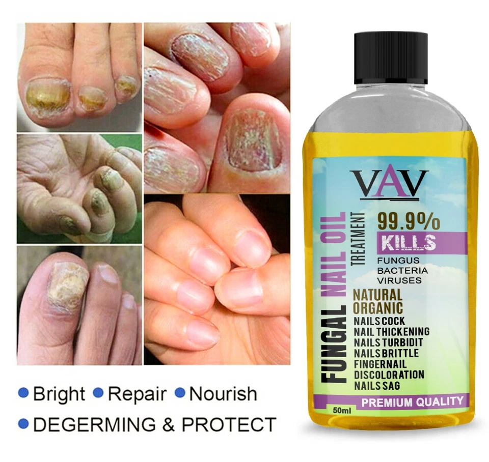 VAV Antimykotische Behandlung Pilz effektive Fingerzehe Nagelreparatur flüssige Lösung UK