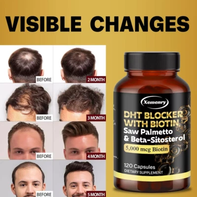 DHT Blocker 120 Kapseln Biotin, Sägepalme, Beta-Sitosterol, fördert das Haarwachstum - Bild 1 von 4