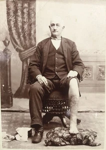 Cabinet Card Antique Medical Photo Man Leg Injury Diabetes CONVERSE INDIANA - Foto 1 di 4