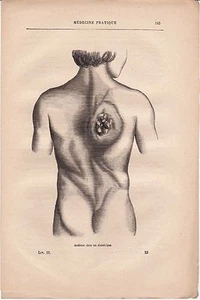 Alte medizinische Gravur 19 - Praktische Medizin - Milzbrand bei einem Diabetiker - Bild 1 von 1