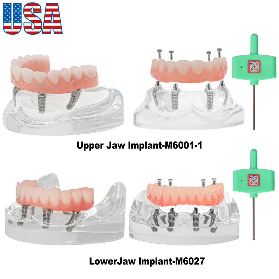 US Dental All-on-4 Implant Model Upper/Lower Jaw-Clear With 4 Screws Overdenture - Image 1 of 4