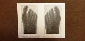 I raggi X nel 1895 Negative di un piede Istituto fisico Regia Università Padova - Picture 1 of 1