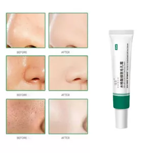 1x 30ml Salicylic Acid Cleansing Cream Acne Cream Remove Shrink Pore - Foto 1 di 12