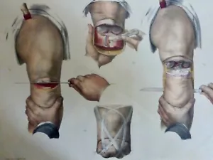 1850 Chirurgia Anatomia Amputation Di La Gamba 1 Stampa Litografia - Imagen 1 de 3