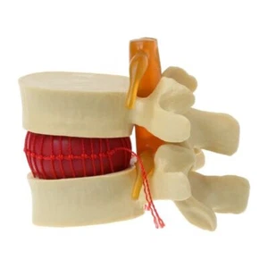 Vertebre lombari umane anatomiche modello malattia degenerativa dell'allargamento modello giallo - Foto 1 di 10