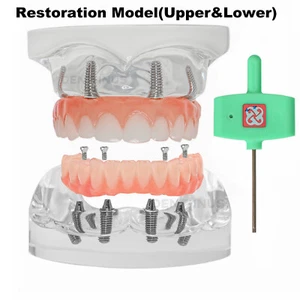 Dental 4 Implants Demo Implant Teeth Model Restoration Overdenture Upper/Lower - Picture 1 of 32