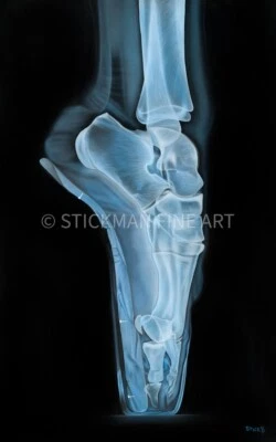 Bailarina Trevor Stickman rayos X Elton John edición limitada firmada arte lienzo Foto 1 de 4