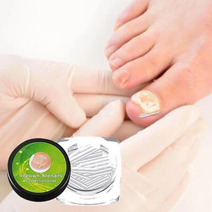 20PCS * Ingrown Toe Foot Nail Correction Sticker Pedicure Tool Toenail Corrector - Picture 1 of 10