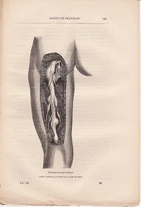 Ancienne gravure médicale 86 - Médecine pratique - Névromes du nerf sciatique - Picture 1 of 1