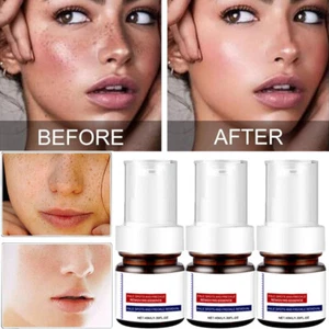1-3 Suero Eliminador de Blanqueamiento y Pecas Crema Eliminador de Manchas Oscuras Esencia de Pecas - Imagen 1 de 20