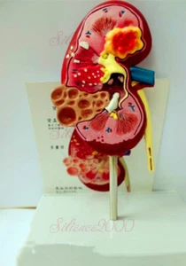 Human Anatomical Anatomy Kidney Diseased Pathological Stone Organ Medical Model - Picture 1 of 4