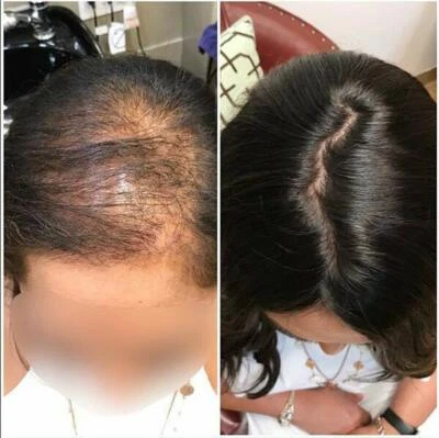  Women Topper Chinese Culticle Hair Systems Clips Injection Silk Top Pieces TP36 - Image 1 of 4