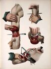 ANTIQUE 19TH C. MEDICAL  PRINT EXAMPLES OF ARM AMPUTATION A3 POSTER ART PRINT
