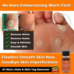 NEW FAST WART REMOVER LIQUID SKIN TAG NATURAL SAFE TREATMENT MOLES SAFE VERRUCA - Picture 1 of 6