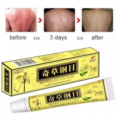 1 BODY Natural Body Psoriasis Eczema Rosacea Cream Ointment Gel Body Skin Care - 1 Tube