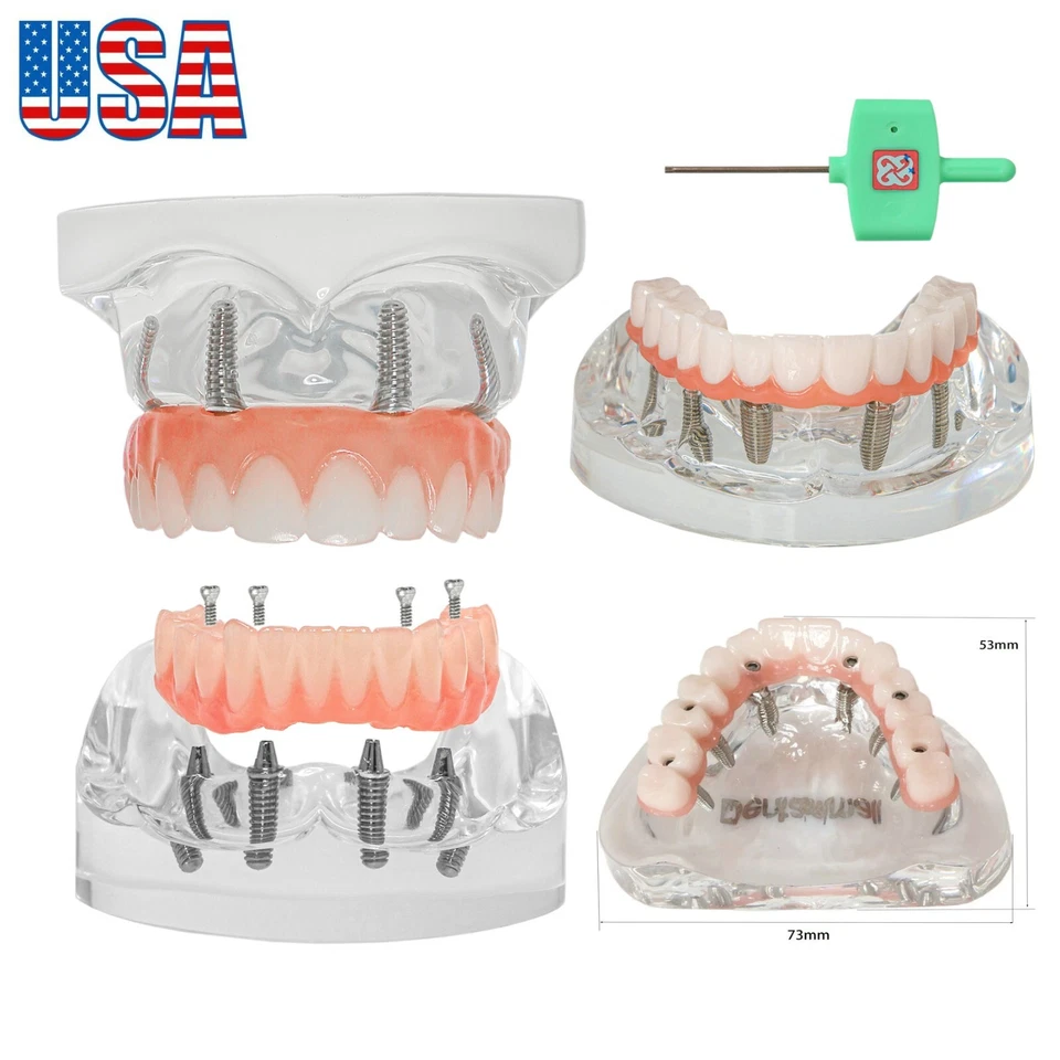 US Dental Overdenture Restoration Teeth Model Upper/Lower Jaw Type With 4/6Screw - Image 1 of 4