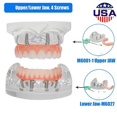US All-on-4 Dental Overdenture Model Set Upper/Lower Jaw Transparent, 4 Screws - Image 1 of 4