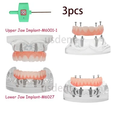 Implant Upper/Lower 4 Implants Demo Teeth Model Restoration Overdenture 3pcs - Image 1 of 4