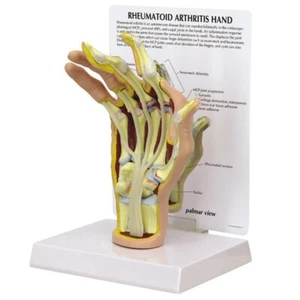 Hand Rheumatoid Arthritis RA Anatomical Model GPI LFA #1931 SEE VIDEO Make Offer - Picture 1 of 5