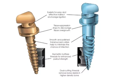 Ormco VectorTAS 12MM/10MM/8MM/6MM MINI-SCREW-PK6