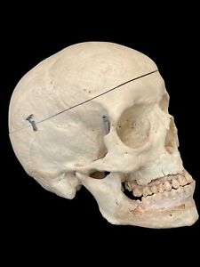 Véritable Crâne Humaine Human Skull Dentiste Médecin Anatomie Cabinet Curiosité