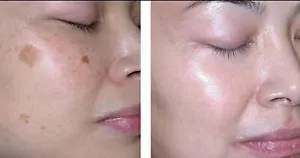 5 Days see Effect! Remove Dark Spots on Face via Sole Concentrated Herb Essences - Picture 1 of 11