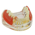 Dental Żuchwa Implant Zęby Model zębów z naczyniami Demo Mosty szczękowe