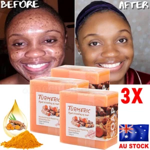 3Pack Turmeric Soap Acne Dark Spots Remove Skin Whitening Body Bleaching Soap - Picture 1 of 15