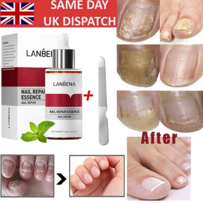 LANBENA Nail Fungus Treatment - Repair Rough/Cracked Nails, Toe & Hand Care