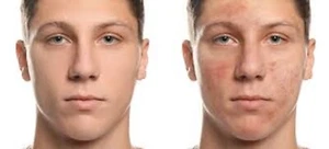 Anti Acne Cream Mask & a Free Cleanser, Herbal Salicylic Acid to Remove Oil Acne - Picture 1 of 10