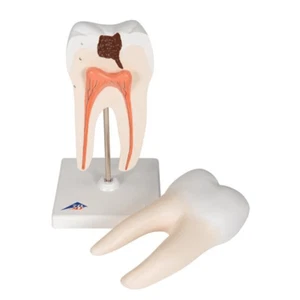 3B Scientific D10/4 Lower Twin-Root Molar with Cavities Human Anatomical Model - Picture 1 of 4