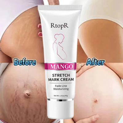 40g Remove Pregnancy Scars Acne Cream Stretch Marks Treatment Maternity Repair - Image 1 of 4