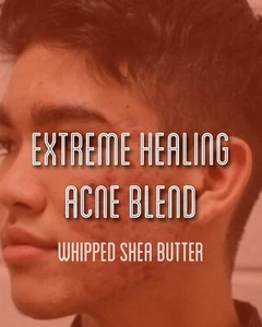 Fra Fra's Naturals | Premium EXTREME Healing Acne Whipped Shea Butter Blend - Picture 1 of 4