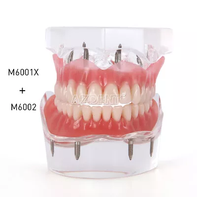 Dental Teeth Model Demo Overdenture Restoration Upper/Lower 4 Implants Mandibula - Image 1 of 2