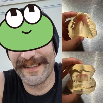 DIENTES FALTANTES PERSONALIZADOS ALETA/StayPlate para parte superior inferior (MATERIAL ACRÍLICO DURO) Foto 1 de 4