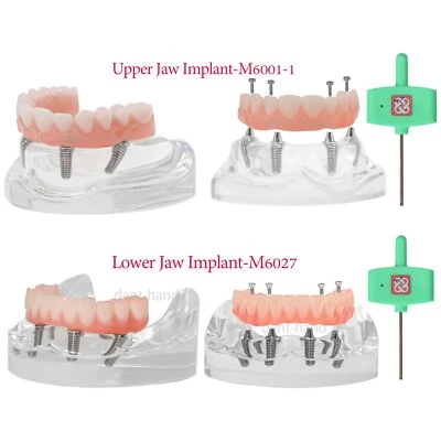 4 implantes dentales superiores/inferiores demostración implante dientes modelo restauración sobredentadura Foto 1 de 4