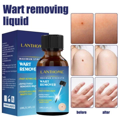 MARKENLOS Wart Remover Liquid Skin Tag Mole Remover Eliminate Feet Corn Warzenentferner