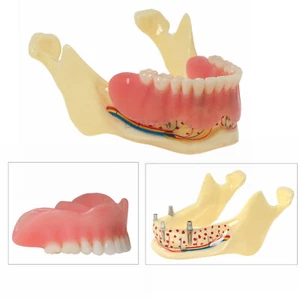 Posiciones de implante óseo transparente modelo tipodonte mandíbula dental con sobredentadura - Imagen 1 de 11