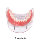 Studium stomatologiczne Nauczanie dorosłych Standardowy model Typodont Demonstracja zębów 2 implanty